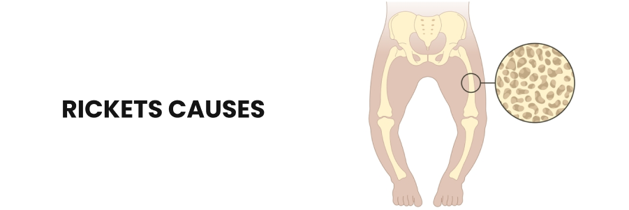 Rickets Causes