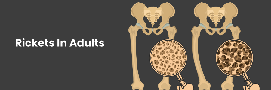 Rickets in Adults