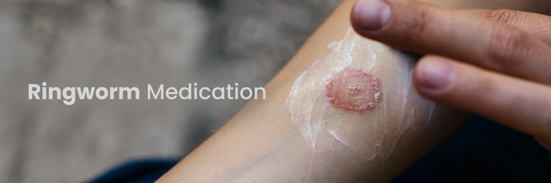 Ringworm Medications