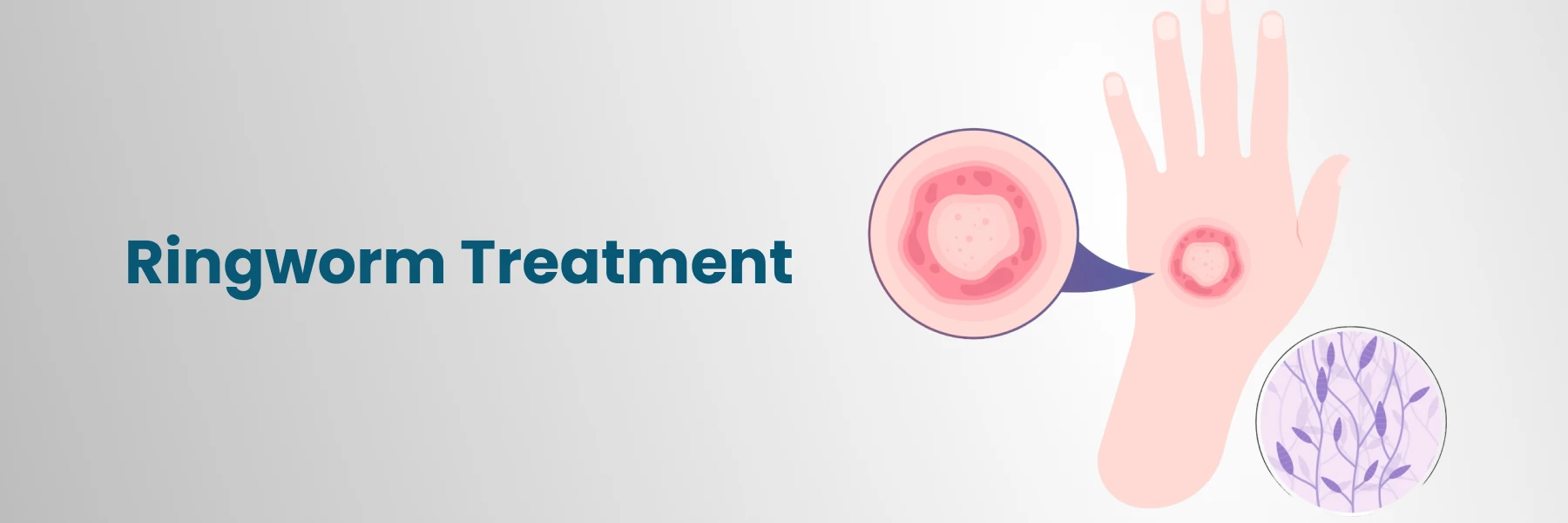 Ringworm Treatment