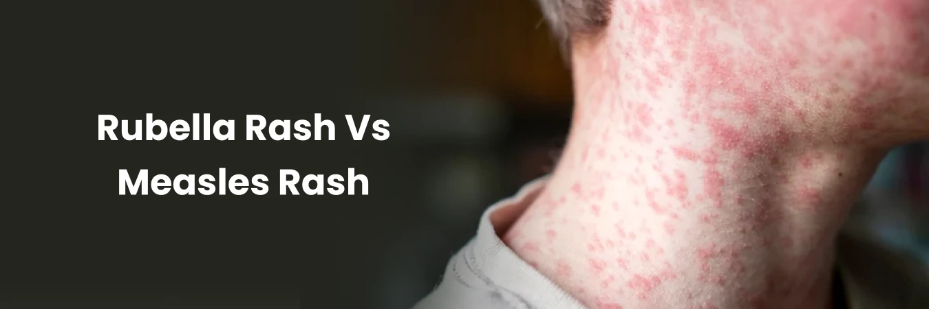 Rubella Rash Vs Measles Rash