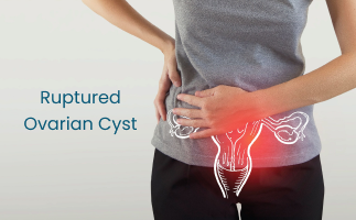 Signs of a Ruptured Ovarian Cyst What Women Should Know