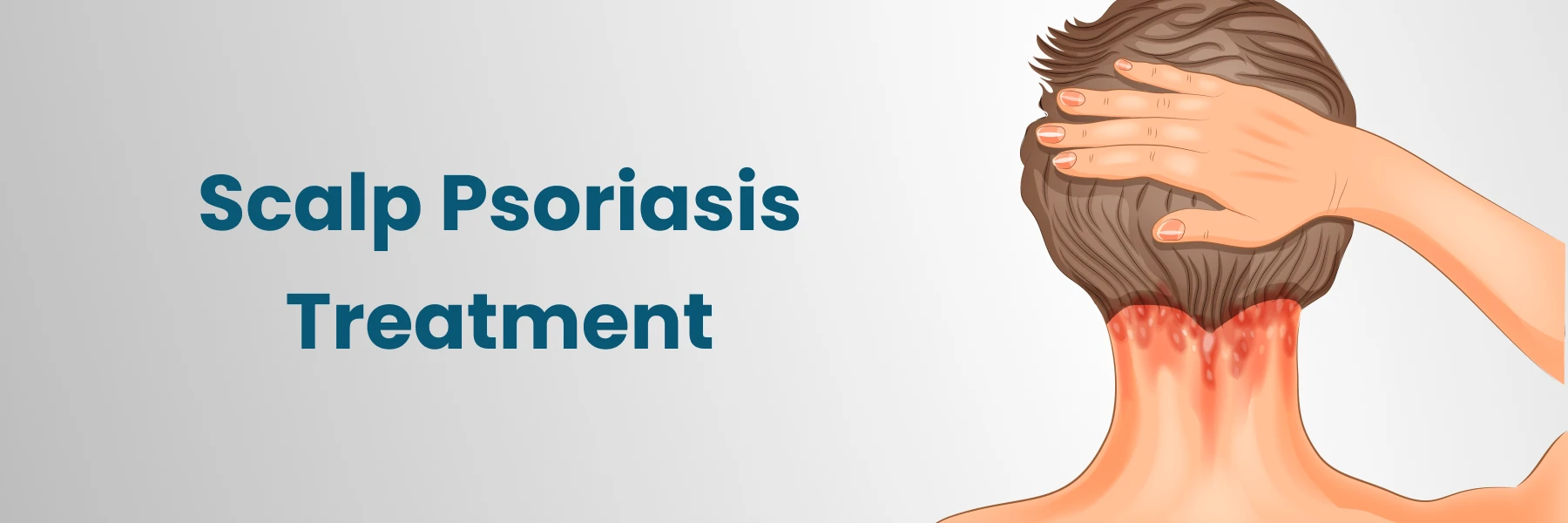 Scalp Psoriasis Treatment