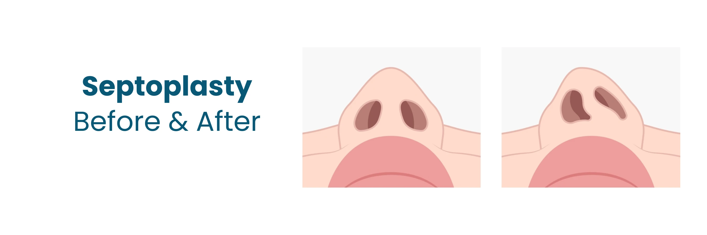 septoplasty before and after