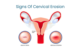 Cervical Erosion Causes Symptoms Diagnosis and Treatment