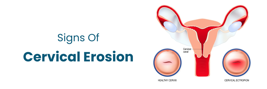 Signs Of Cervical Erosion