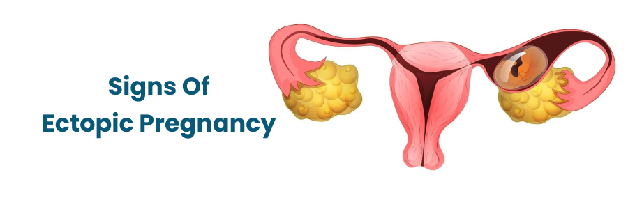 Signs Of Ectopic Pregnancy