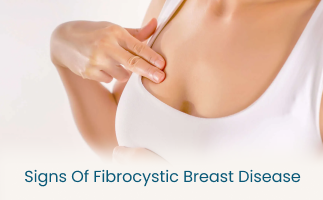 Signs of Fibrocystic Breast Disease