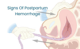 How to Identify the Signs of Postpartum Hemorrhage