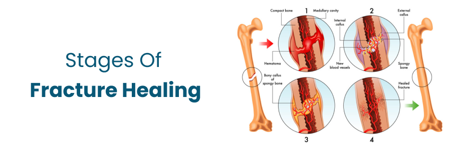 Stages Of Fracture Healing