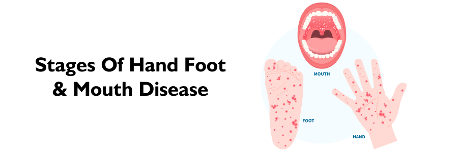 Stages of Hand, Foot, and Mouth Disease: Symptoms and Prevention