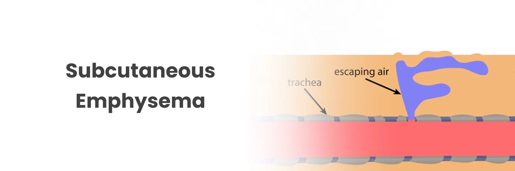 Subcutaneous Emphysema