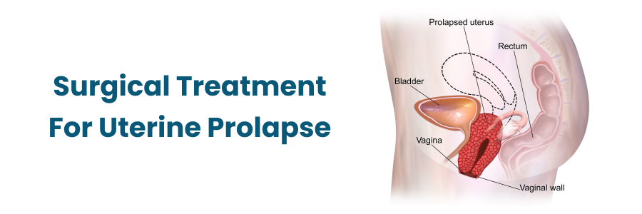 Surgical treatment for uterine prolapse