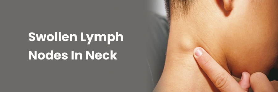 Swollen Lymph Nodes in Neck