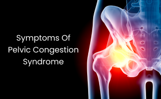 How to Identify the Symptoms of Pelvic Congestion Syndrome