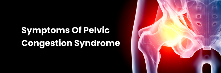 Symptoms of Pelvic Congestion Syndrome