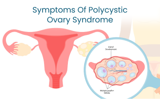 PCOS Symptoms and Management Strategies