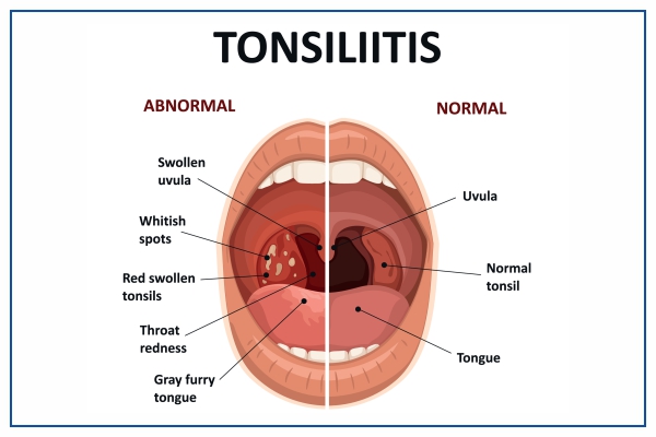 tonsillitis treatment at home