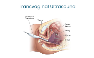 Transvaginal Ultrasound A Vital Diagnostic Procedure