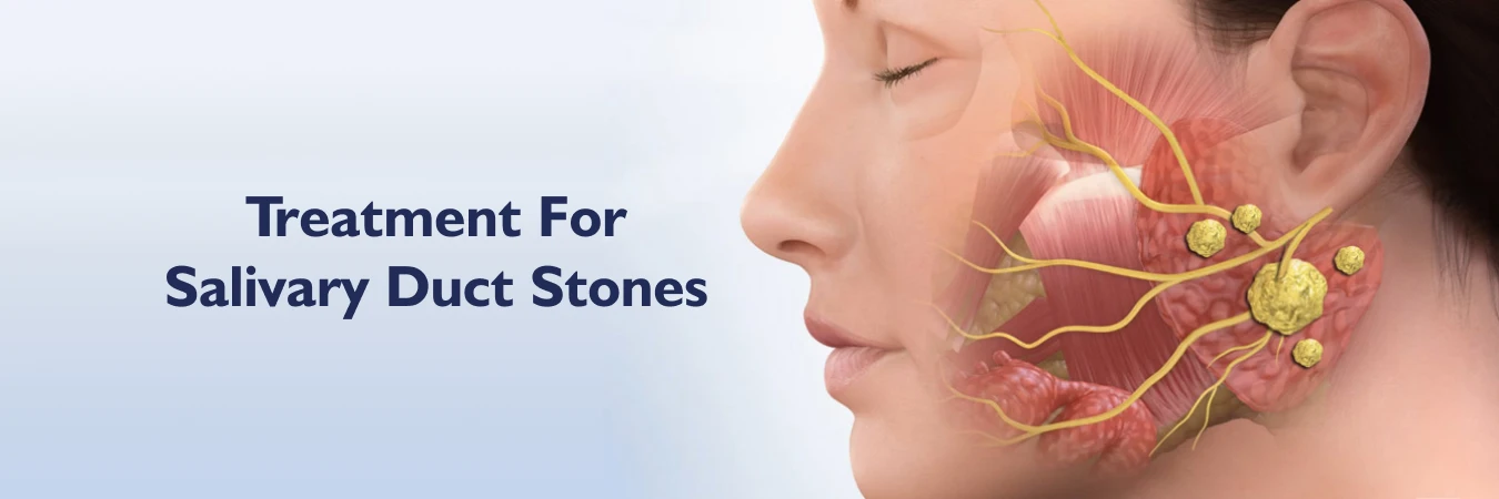 Treatment For Salivary Duct Stones