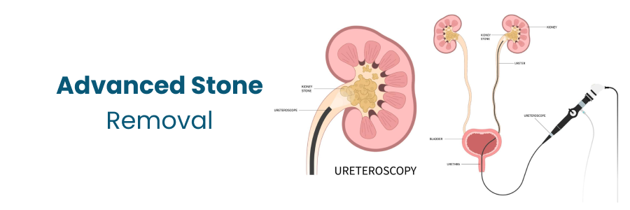 Treatments for Kidney Stone Removal
