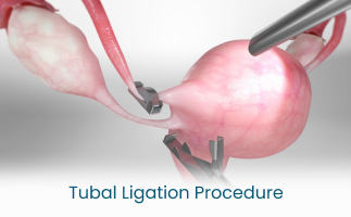 Tubal Ligation Procedure for Permanent Birth Control