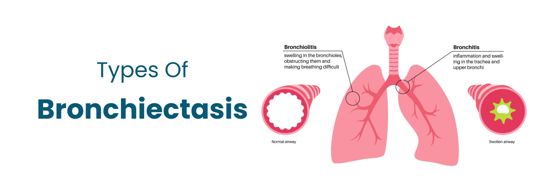 Types of bronchiectasis