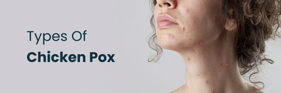 Types Of Chicken Pox