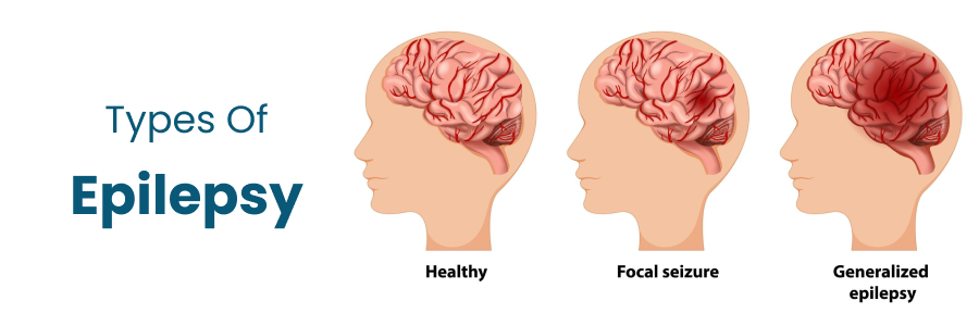 Types Of Epilepsy