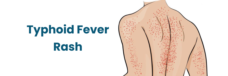 Typhoid Fever Rash