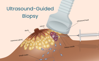 UltrasoundGuided Biopsy Uses Procedure Benefits and Risks