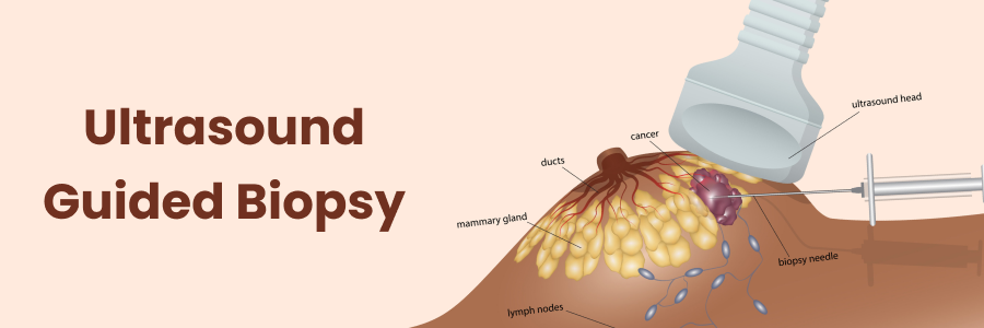 Ultrasound-Guided Biopsy