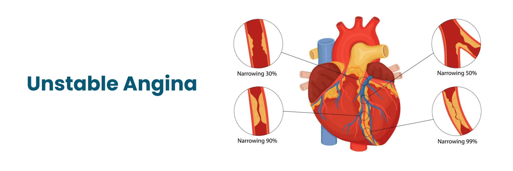 unstable angina