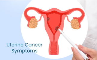 Recognizing the Symptoms of Uterine Cancer Early