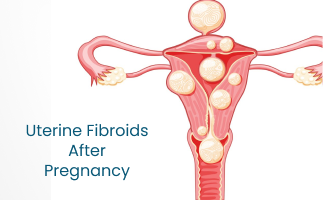 Managing Uterine Fibroids Symptoms After Pregnancy