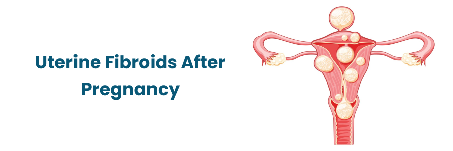 Uterine Fibroids After Pregnancy