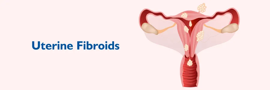 Uterine Fibroids