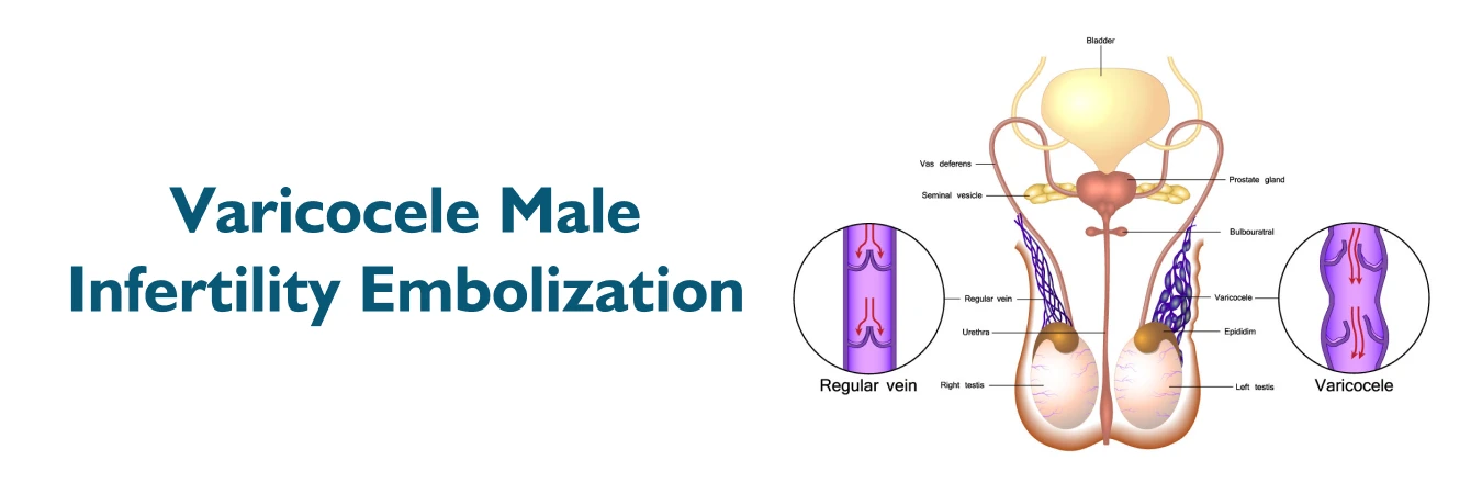  Varicocele Male Infertility Embolization