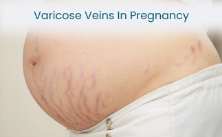 Effective Ways to Manage Varicose Veins During Pregnancy