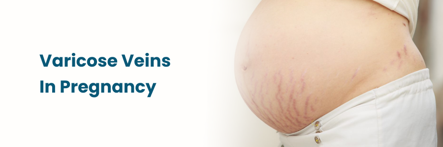 Varicose Veins In Pregnancy