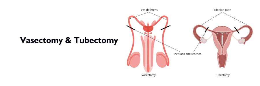 vasectomy and tubectomy