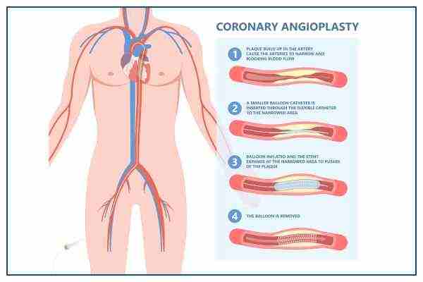 how angiography is done