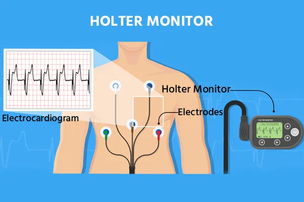 Holter Monitoring