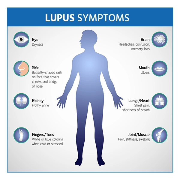 Lupus : Complications & Treatment | Contact our with experts