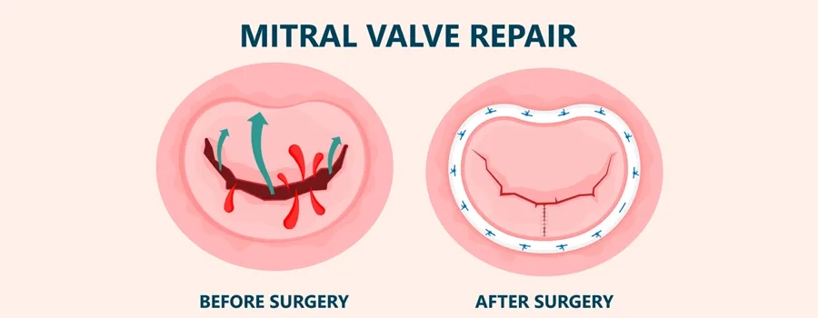 Remplacement avancé de la valve mitrale dans les hôpitaux Medicover