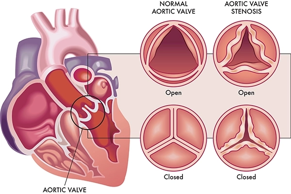 SAVR avancé (remplacement chirurgical de la valve aortique) chez Medicover