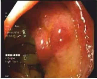 acitrom-induced-pseudo-obstruction-1