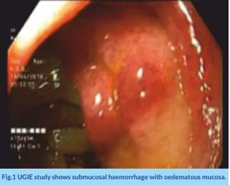 acitrom-induced-pseudo-obstruction-2