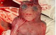 anencephaly