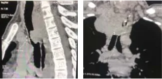 central-airway-obstruction-1